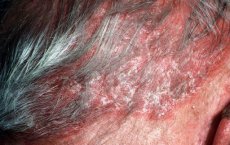 Haarprobleem - Gevoelige hoofdhuid